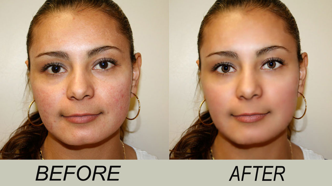 3 Home Remedy Tip That Are Guaranteed To Work To Eliminate Dark Spot And Clear Scars