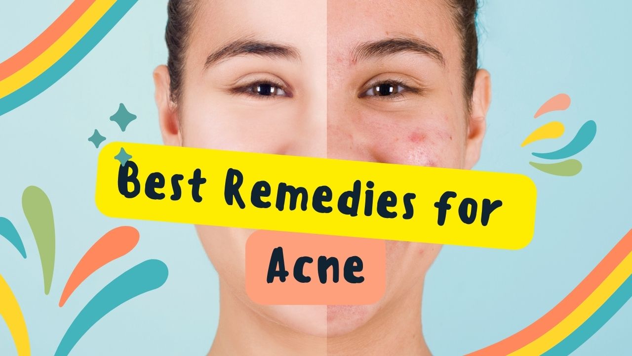 Best Remedies for Acne